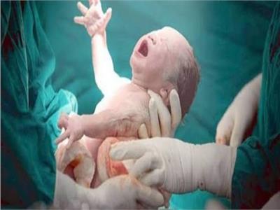 ولادة نادرة لطفلة بداخل بطنها جنين