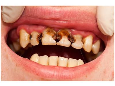طبيبة اسنان : التسوس قد ينتقل من تقبيل شخص يعاني منه