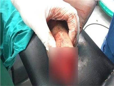 عامل يقطع يد زميله بـ «سيف» في الغربية