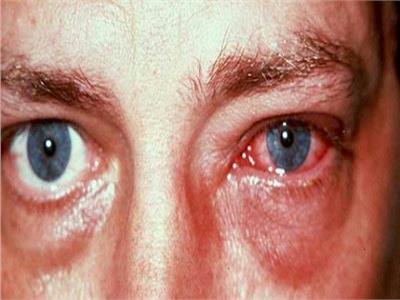 تعرف على مرض إلتهاب العين.. وأبرز أعراض الإصابة