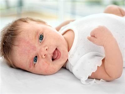 أعراض الصدفية عند الرضع