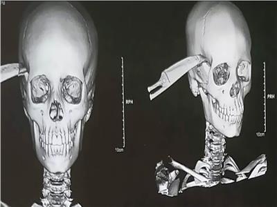 استخراج سكين من جمجمة طفل بمستشفى جامعة أسيوط 