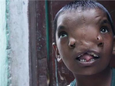 طفلة هندية مولودة بأنفين تتحول لإله في الهند