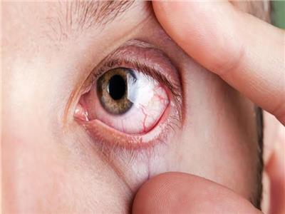 دراسة: أكتشاف علاج فعال لسرطان العين القاتل 