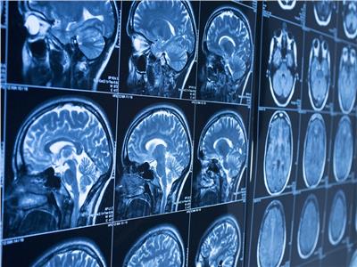 «مرض غامض».. يضرب دماغ الإنسان ويتسبب في وفاة 6 أشخاص في كندا