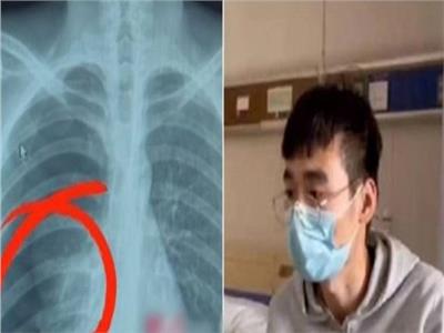«حاول يغني كاريوكي»..شاب صيني يتعرض لانفجار في الرئة 