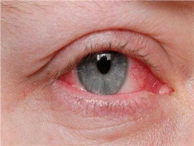خبراء: العيون الوردية علامة خفية تحذر من الأصابة بكورونا