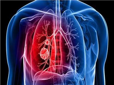 مكمل «بيتا كاروتين» قد يزيد من فرص الإصابة بسرطان الرئة