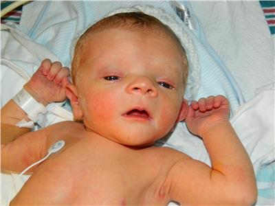 منها كبر الرأس وقصر الرقبة.. 10 أعراض لمتلازمة نونان عند الرضع