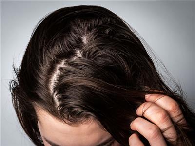 للجنس الناعم| العلاجات الطبيعية البسيطة للمساعدة في محاربة الشعر الدهني