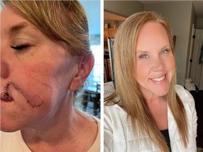 أمريكية تكتشف الإصابة بسرطان الجلد بعد ظهور «وحمة» على وجهها