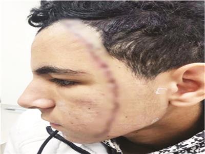 طالب الإعدادي مزق وجه زميله بـ50 غرزة