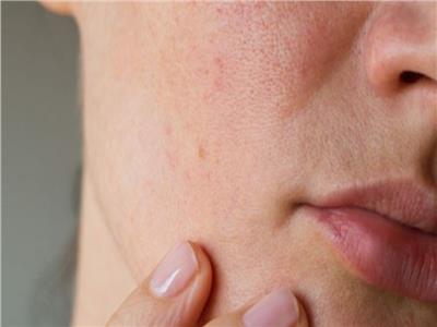 9 علامات في بشرتك تسببها أمراض الكلى.. أبرزها جفاف البشرة والحكة 