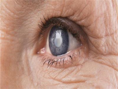 أستاذ عيون: المياه الزرقاء مرض وراثي وتؤدى إلى عدم الرؤية