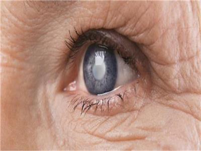 أستاذ عيون: مرضى المياه الزرقاء لا يشتكون من ضعف النظر.. والمرض وراثي |فيديو 