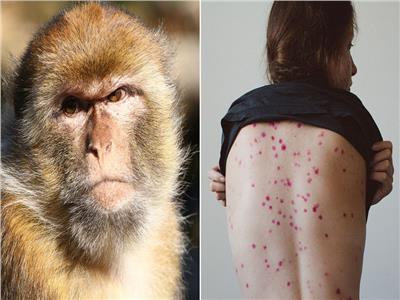 الصحة العالمية تستعرض آخر مستجدات الإصابات بجدري القرود | مباشر