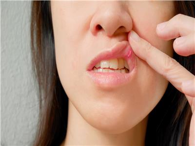 5 علاجات بسيطة لشفاء تقرحات الفم في وقت قصير