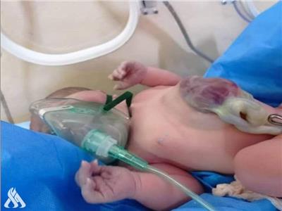 العراق.. ولادة طفلة بقلب خارج القفص الصدري في بابل