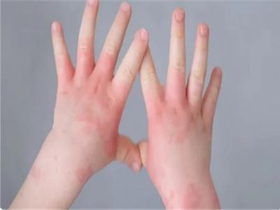 انفلونزا الطماطم.. مرض جديد «شديد العدوى» يصيب الأطفال