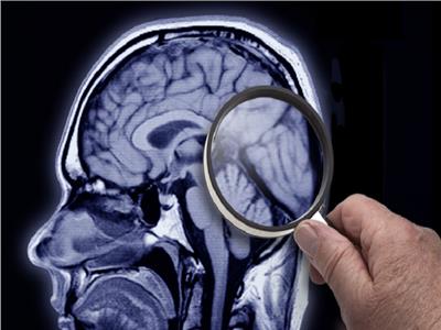لخطر الإصابة بـ «مرض الزهايمر».. تحديد «بروتين دقيق» في الدماغ 