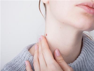 علامات تشير إلى خطر الإصابة بأنواع سرطان الجلد خطيرة