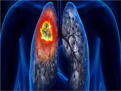  يسبب «سرطان الرئة».. استشاري علاج الأورام يحذر من الجلوس مع المدخنين | فيديو