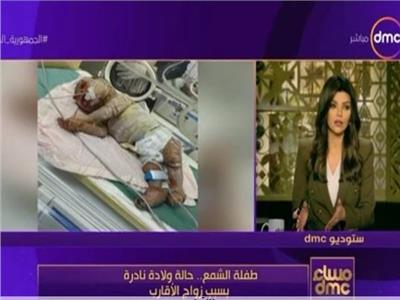 طفلة الشمع .. ولادة حالة نادرة بسبب زواج الأقارب بمستشفي المحلة العام