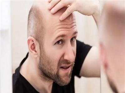 مشروبات تزيد من خطر تساقط الشعر لدى الرجال