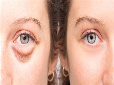 لعلاج الانتفاخات حول العينين.. 5 وصفات لزيوت طبيعية