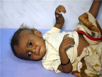 «اليونيسيف»: أكثر من مليوني طفل في اليمن يعانون من سوء تغذية حاد