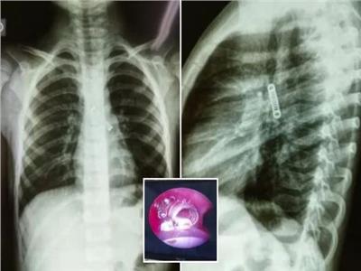 طبيب يعثر على «سوستة حديدية» داخل رئة طفل       