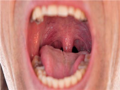 جفاف الفم أحد أعراض «العلم الأحمر» لخمسة أمراض خطيرة.. أبرزها الزهايمر
