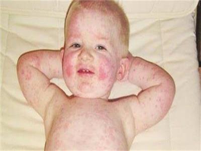 معدية وتسبب طفح جلدي.. أعراض «الحمى الوردية» التي تصيب الأطفال 