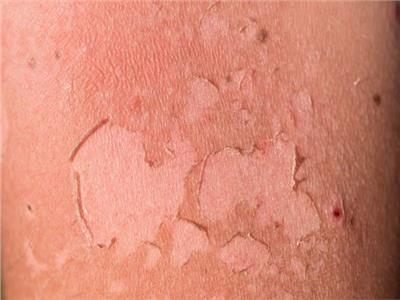 كيف تتعامل مع تقشير الجلد بعد احتراقه من الشمس؟  