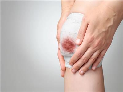 للجروح.. 5 علاجات منزلية مفيدة لتقليل الألم ومنع العدوي