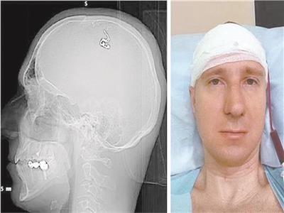 حدث بالفعل| رجل روسي أجرى جراحة لنفسه في المُخ للسيطرة على الأحلام