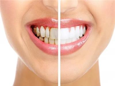 4 فئات أكثر عرضة لمشاكل الفم والأسنان