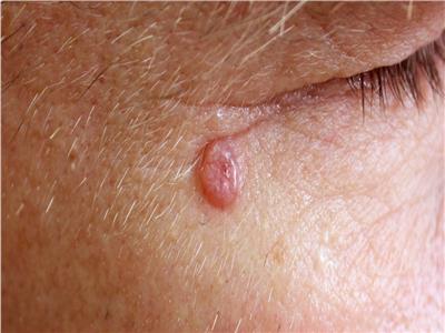 الأعراض الرئيسية لسرطان الجلد «غير الميلانيني»