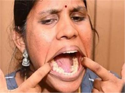فتاة تدخل موسوعة جينيس بسبب «فرط الأسنان»