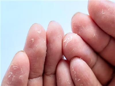 الأمراض الجلدية الأبرز.. 5 أسباب وراء تقشر بشرتك