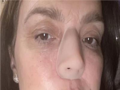 امرأة بلا أنف.. تشخيص خاطيء يغير حياتها | صور