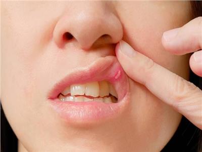 لصحة أفضل.. نصائح للتعامل مع قرح الفم​ المؤلمة
