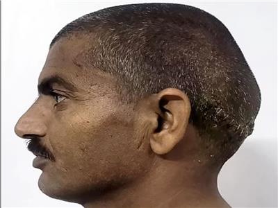 عاش معه 19 عامًا.. إزالة ورم بحجم «الشمام» من رأس هندي| صور