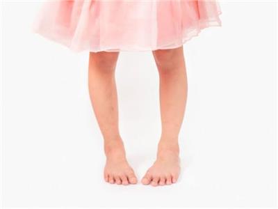 احذري.. 3 أسباب لإصابة الأطفال بتقوس الساقين 