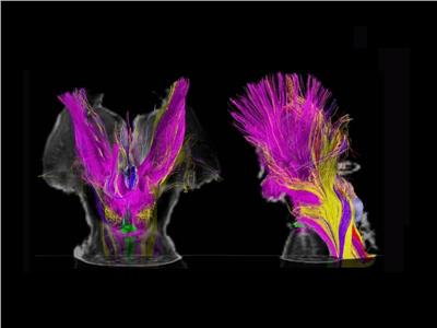 الرنين المغناطيسي يكشف عن مراحل الوعي المذهلة في الدماغ