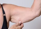 علاج ترهل ذراعيك يبدأ بالوقاية من السمنة