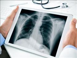 تجنب عمل الأشعة غير الضرورية على الصدر