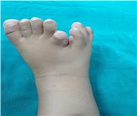 صور| لأول مرة.. فريق طبي ينجح في استئصال قدم زيادة لطفلة بمستشفى الطور