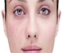 6 أسباب تسبب حساسية الوجه وإحمرارها