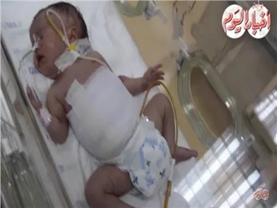 فيديو "وعد" طفلة حملت توأمها في بطنها